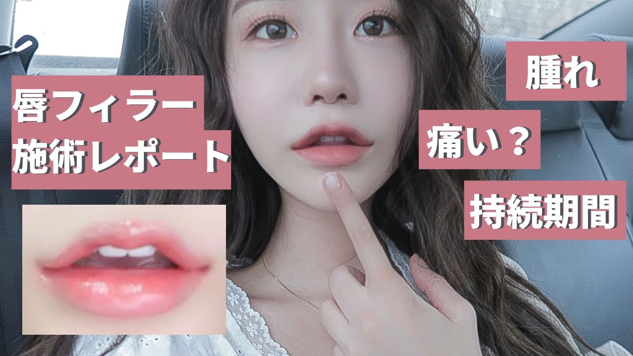 唇 フィラー と は