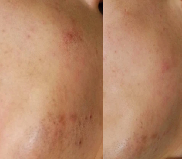 メンズにおすすめのハーブピーリングは？肌荒れやニキビに悩む男性の施術例とともに解説！