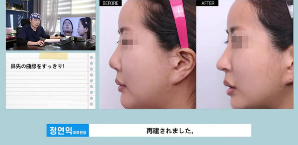 韓国　美容整形　鼻